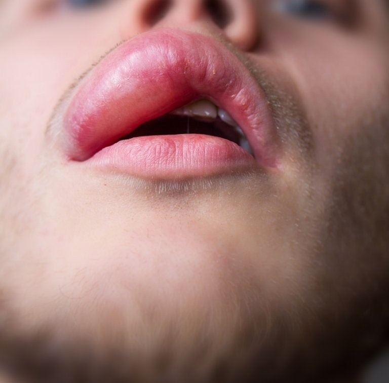 ¡Adiós a los labios inflamados! Remedios caseros y causas menos comunes de inflamación en la boca