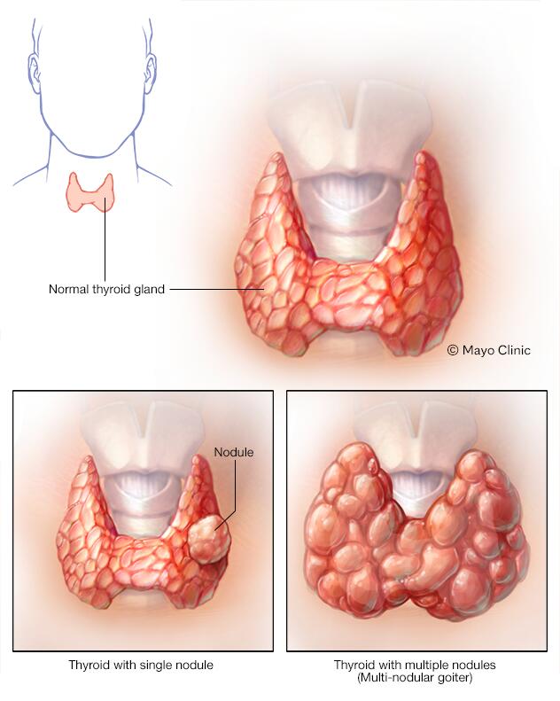 ¡Adiós nódulos en la tiroides! Descubre cómo eliminarlos de tu vida