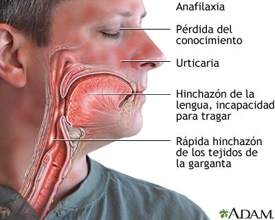 ¡Anafilaxia: La reacción alérgica más peligrosa y divertida!