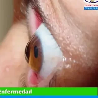 Ceratocone: ¿Qué es, síntomas, causas y tratamiento para esta condición ocular?