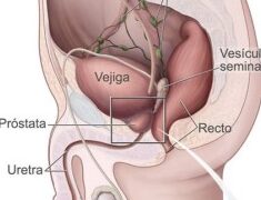 Cistectomía: procedimiento quirúrgico para el tratamiento del cáncer de vejiga
