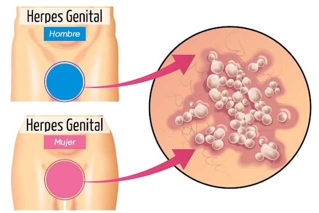 ¡Descubre todo sobre el herpes genital y cómo prevenirlo!