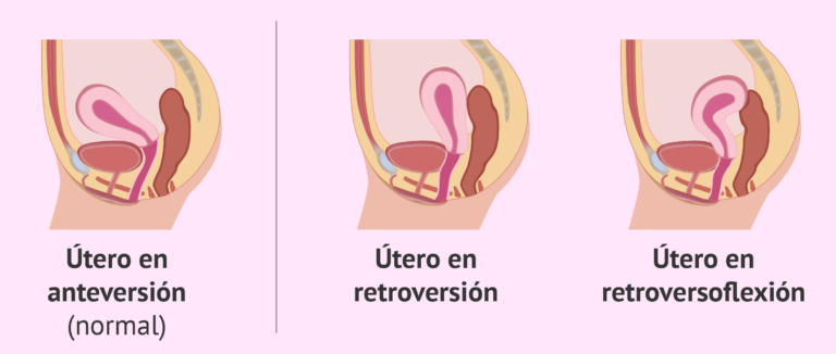 ¡Descubre todo sobre el útero retrovertido y sus impactantes efectos en la fertilidad!