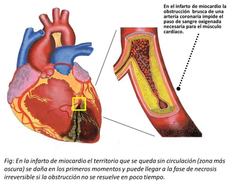 El infarto agudo de miocardio: una advertencia mortal para el corazón