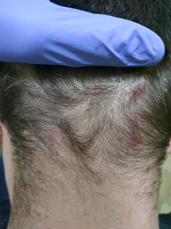 Foliculitis en el cuero cabelludo: síntomas, causas y tratamientos