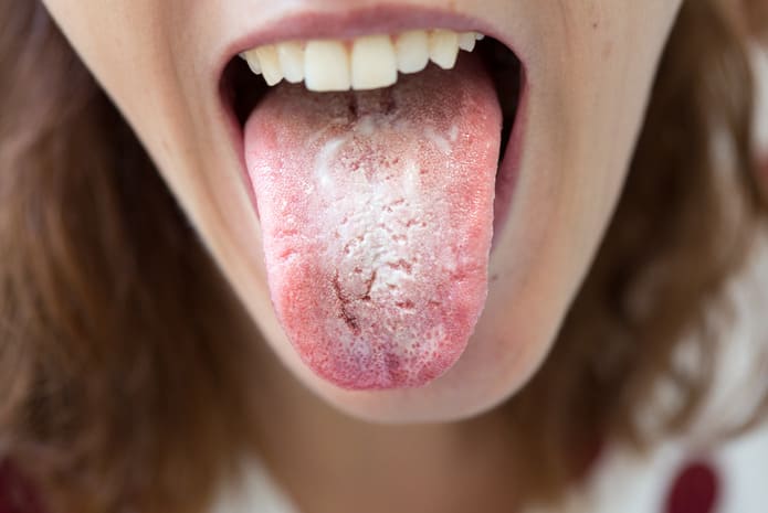 La Candidiasis Oral: Síntomas, Causas y Tratamientos