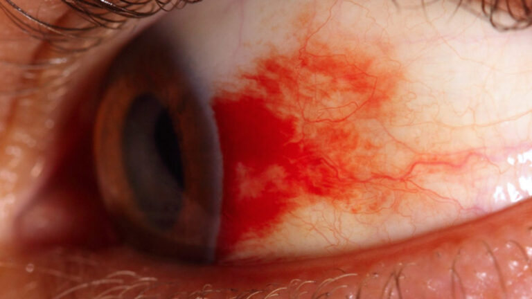 Mancha vermelha no olho: causas e tratamentos