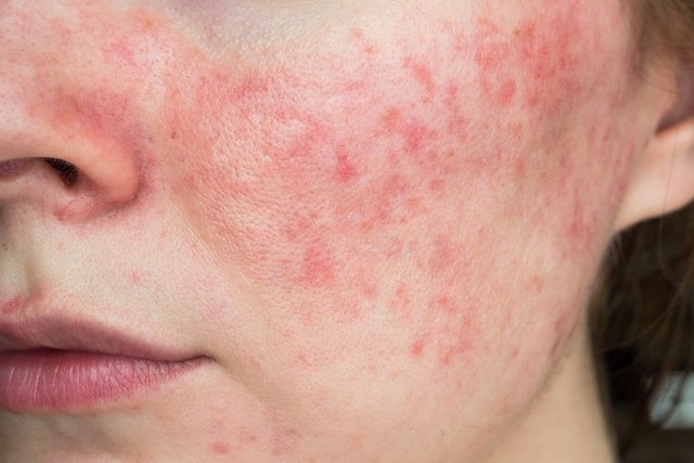 Manchas rojas en la piel: causas y tratamientos