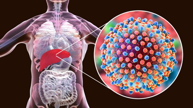 Nuevos conceptos en la hepatitis: Hepatitis D y Hepatitis G