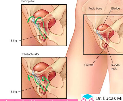 Prolapso uterino: causas, sintomas y tratamiento