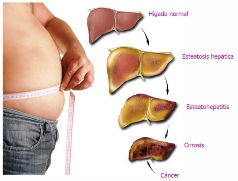 Síntomas clave de la acumulación de grasa en el hígado