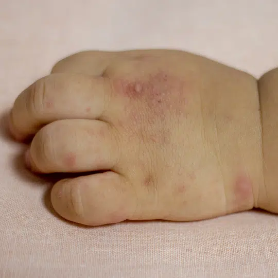 Todo lo que necesitas saber sobre el virus de mano, pie y boca