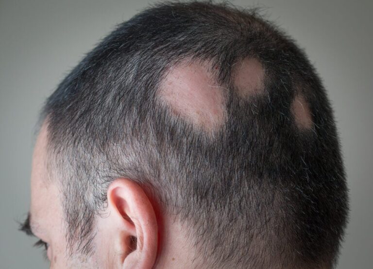 Todo sobre la alopecia: síntomas, causas y tratamiento